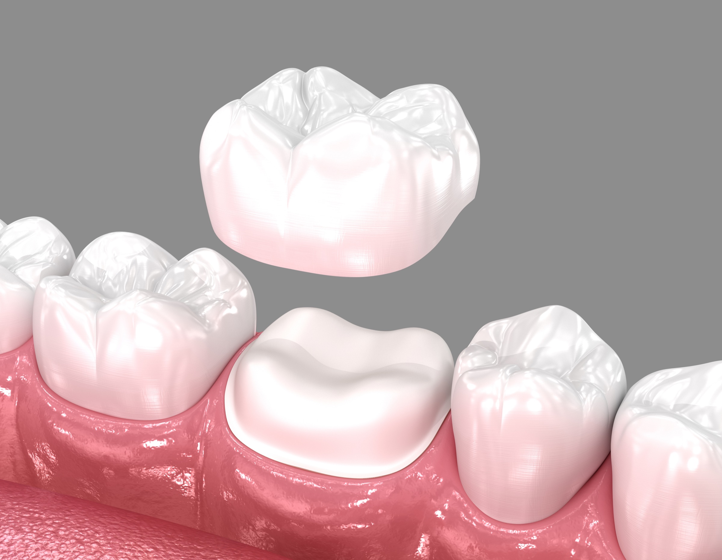 An illustration of a dental crown above a prepared tooth