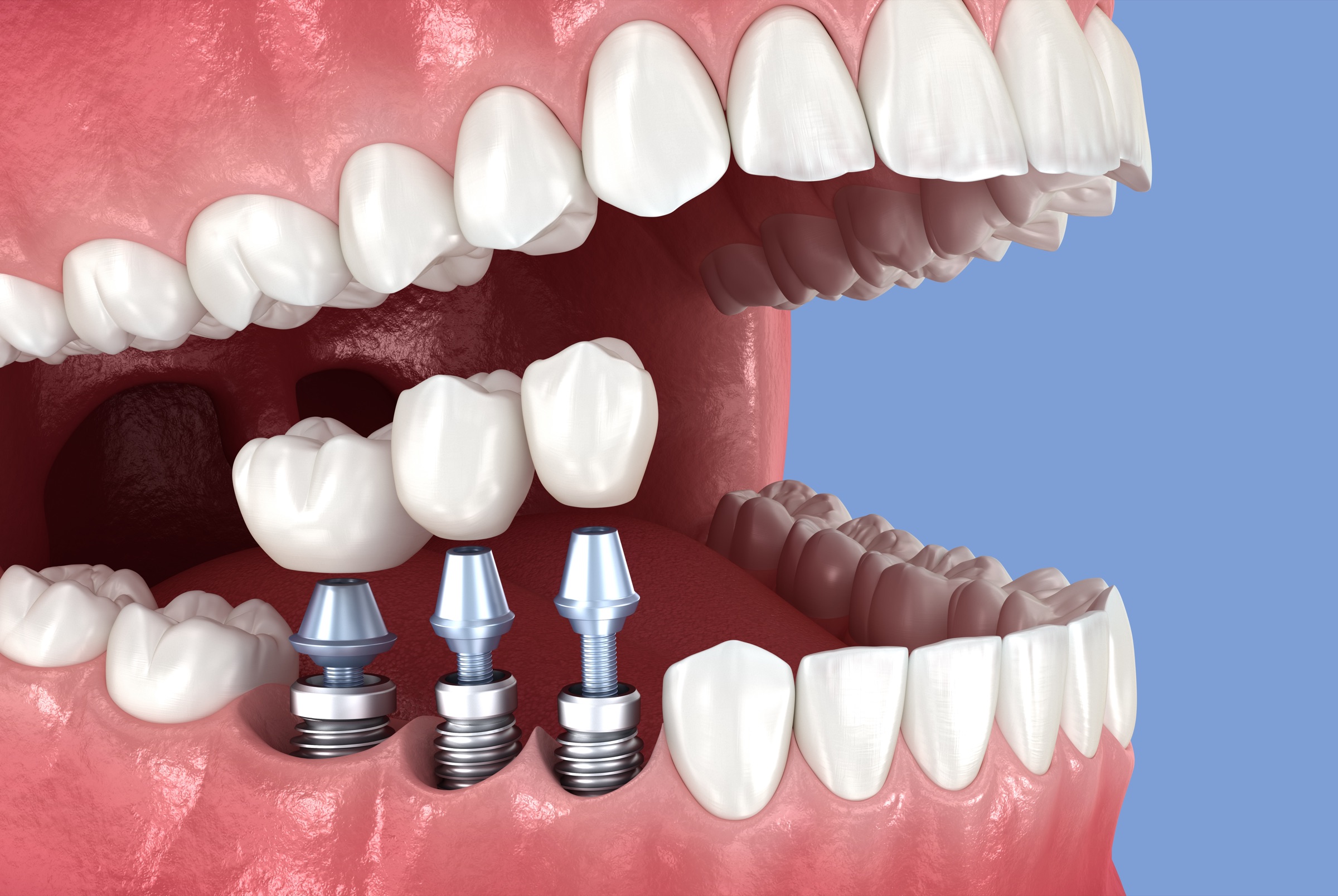 An illustration of dental implants supporting restorations